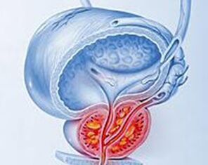 Inflamación de la próstata con prostatitis