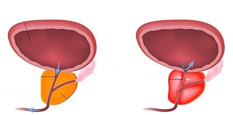Prostata sana e inflamada con prostatitis