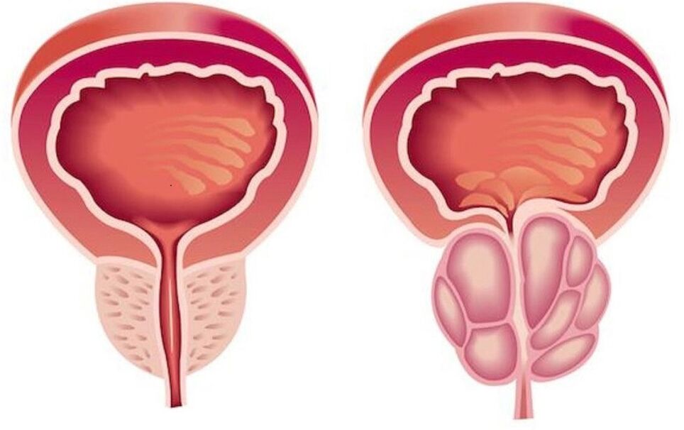 próstata sana e inflamada con prostatitis