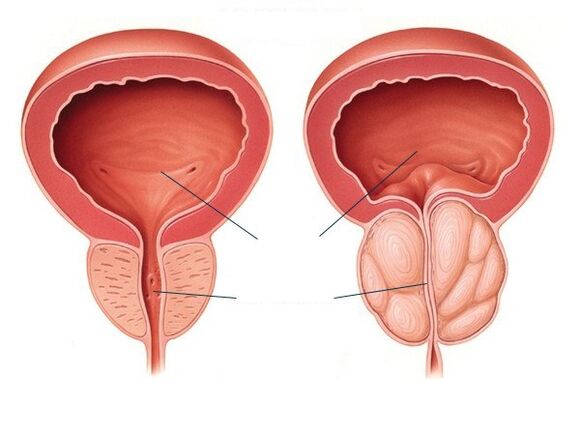 próstata normal y agrandada